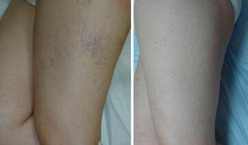 veins before and after applying the gel